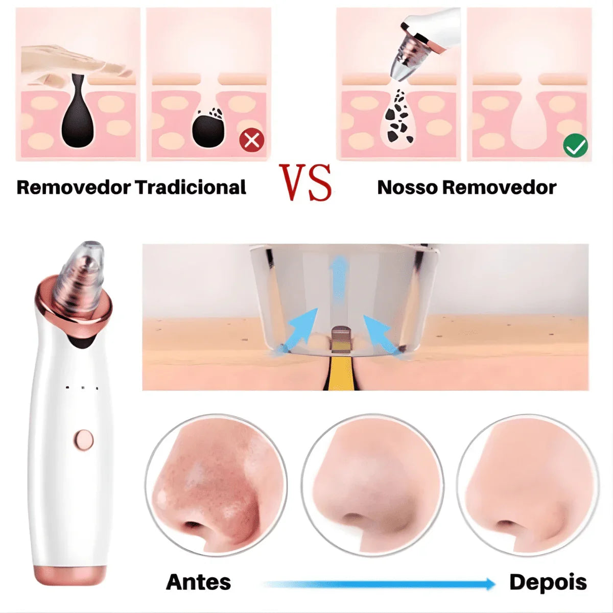 Removedor de Cravos e Espinhas a Vácuo Beauty Clean