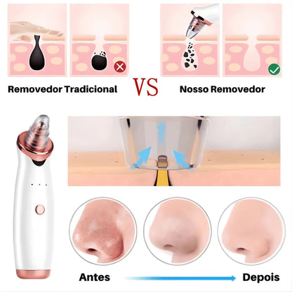 Removedor de Cravos e Espinhas a Vácuo Beauty Clean