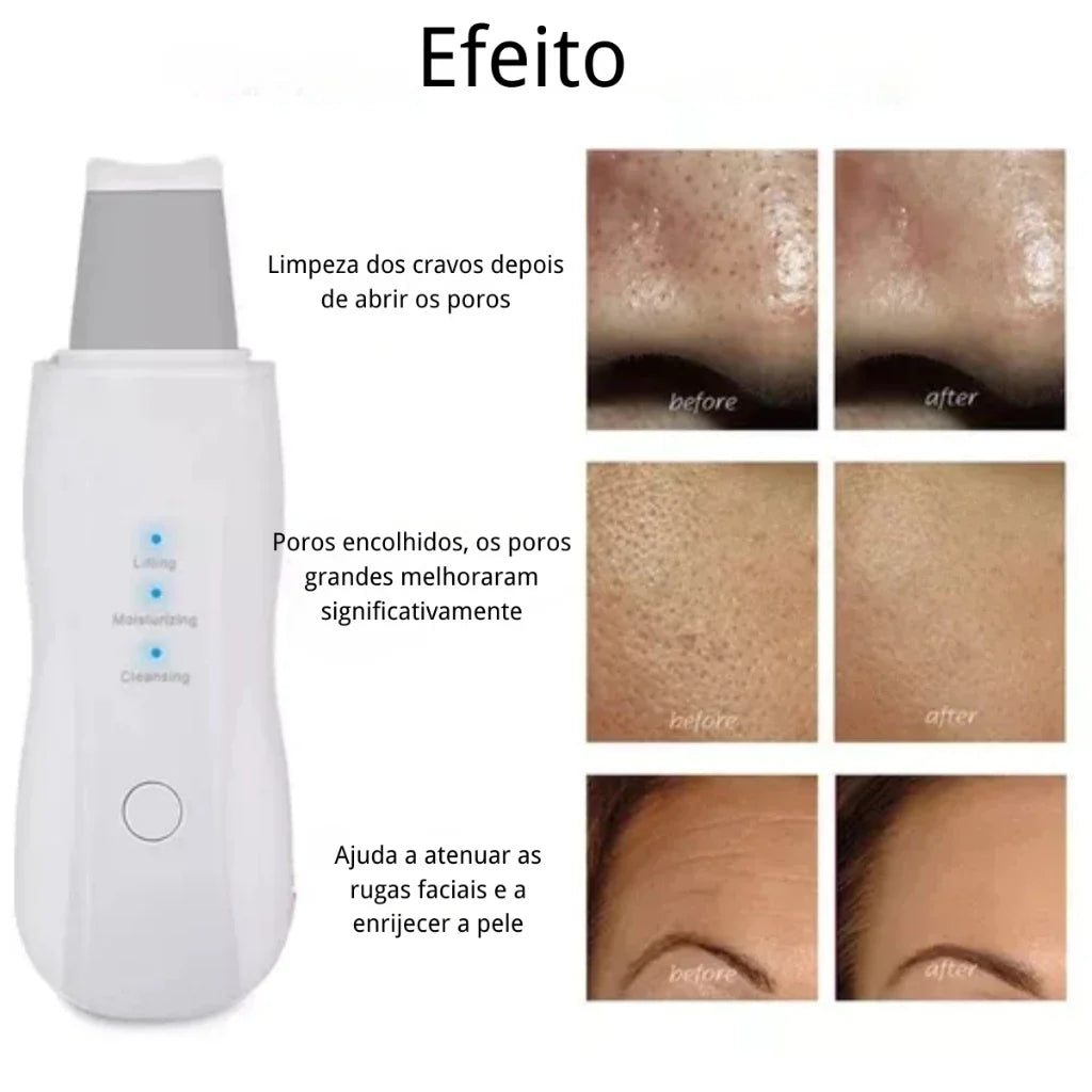 Pure Skin — Peeling Ultrassônico Facial