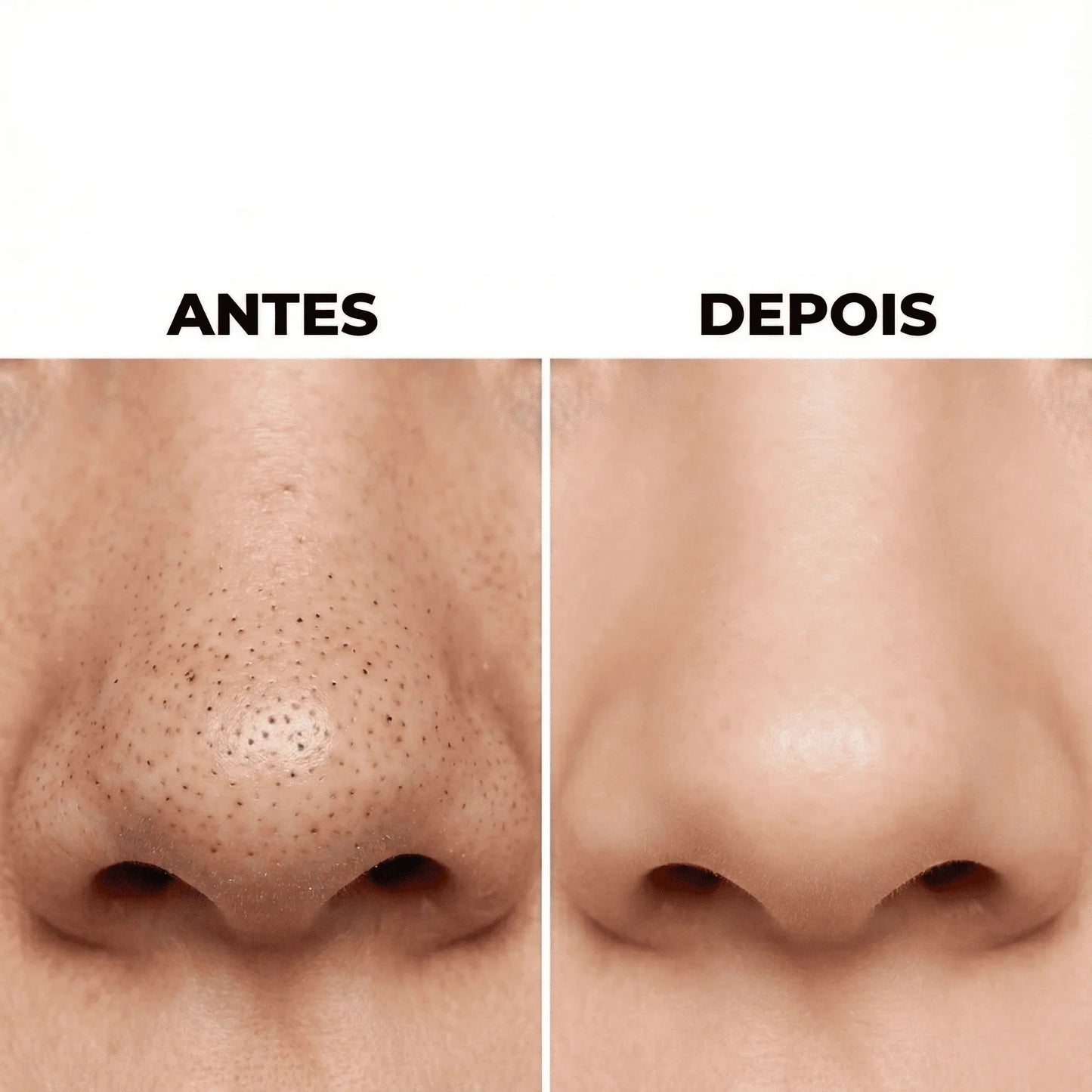 Removedor de Cravos e Espinhas a Vácuo Beauty Clean