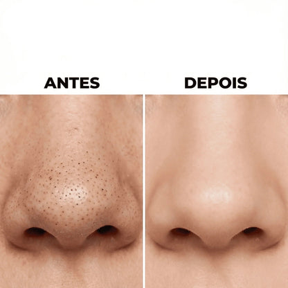 Removedor de Cravos e Espinhas a Vácuo Beauty Clean